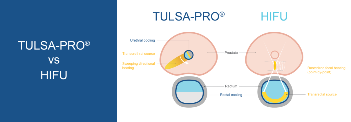 TULSA-PRO-vs-HIFU-blog-post-01-1210x423.png